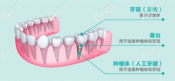 種植牙機(jī)構(gòu)示意圖