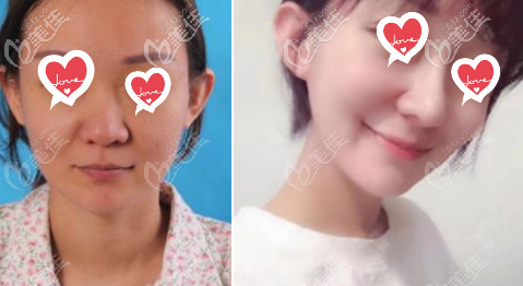 北京美萊隆鼻案例