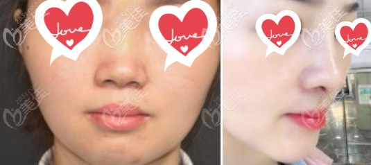 北京柏麗隆鼻案例