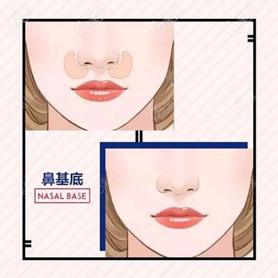 鼻基底凹陷造成的少女型法令紋