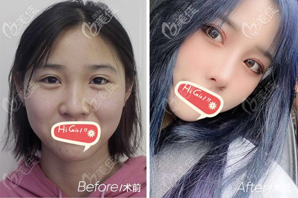 成都西區(qū)顏子云雙眼皮修復(fù)手術(shù)+肋骨鼻術(shù)后效果對比圖 成都西區(qū)顏子云雙眼皮修復(fù)手術(shù)+肋骨鼻術(shù)后效果對比圖