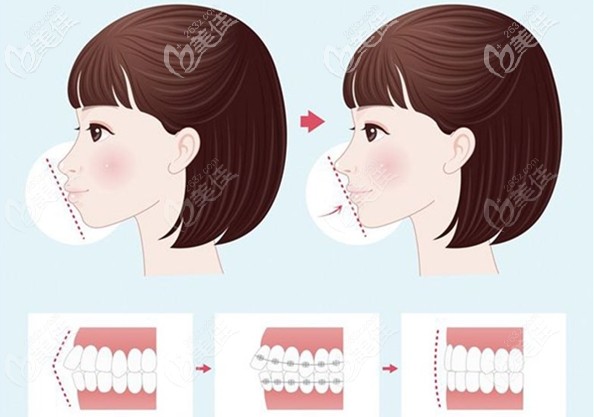 骨性齙牙做正畸后的側(cè)面效果 骨性齙牙做正畸后的側(cè)面效果