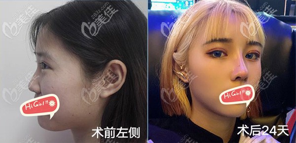 雙眼皮修復(fù)+肋軟骨隆鼻術(shù)后一個月對比效果 雙眼皮修復(fù)+肋軟骨隆鼻術(shù)后一個月對比效果
