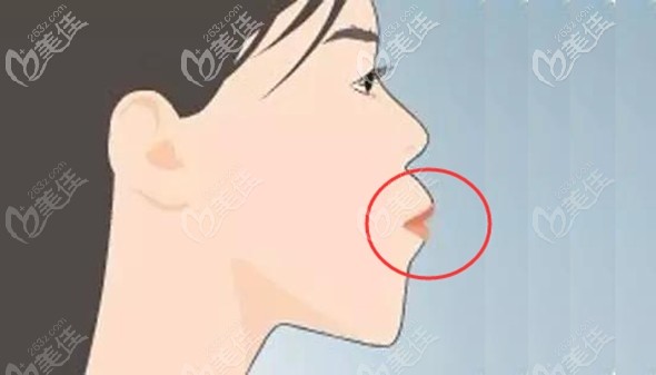 成人齙牙的側(cè)面圖 成人齙牙的側(cè)面圖