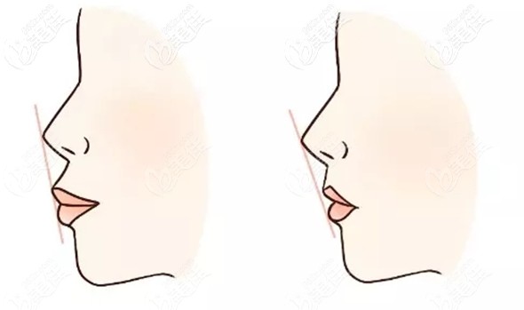 骨性齙牙凸嘴是做正頜還是正畸好呢 骨性齙牙凸嘴是做正頜還是正畸好呢