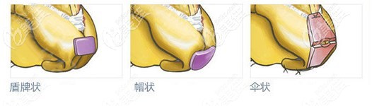 成都西區(qū)醫(yī)院8C骨雕鼻技術(shù)優(yōu)勢 成都西區(qū)醫(yī)院8C骨雕鼻技術(shù)優(yōu)勢