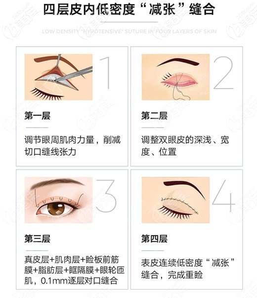 貝塞爾10°美眼綜合技術(shù)優(yōu)勢 貝塞爾10°美眼綜合技術(shù)優(yōu)勢