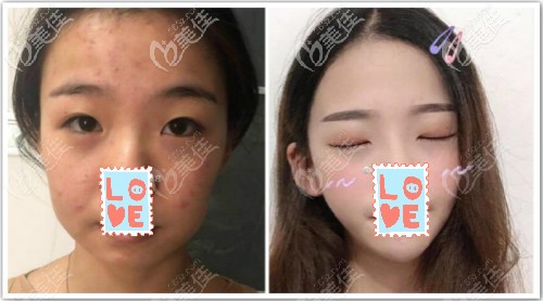 德國(guó)艾pcl線v8全臉提升三個(gè)月效果對(duì)比圖 德國(guó)艾pcl線v8全臉提升三個(gè)月效果對(duì)比圖