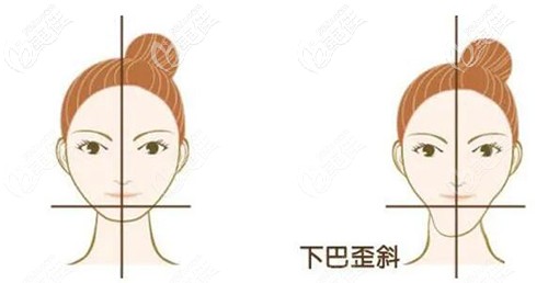 下巴歪斜的原因