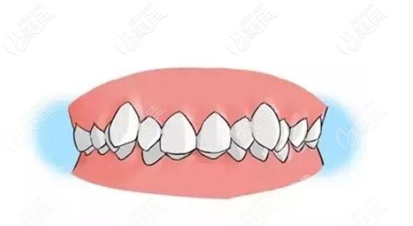 虎牙應(yīng)該選擇矯正牙齒嗎 虎牙應(yīng)該選擇矯正牙齒嗎