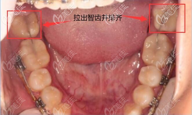 從金屬活動翼技術矯正凸面型的案例中,看如何扶正歪倒的智齒