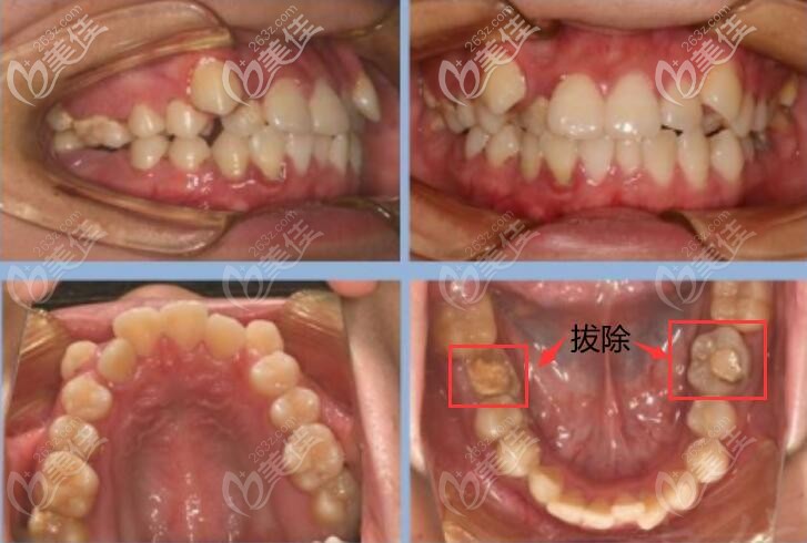 婁底愛牙口腔矯正前案例圖片 婁底愛牙口腔矯正前案例圖片