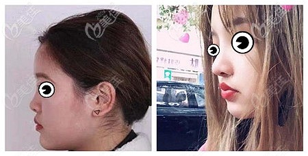 東莞壹加壹耳軟骨隆鼻案例