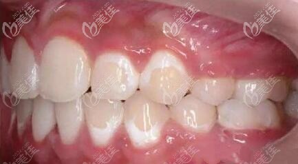 戴金屬鐵牙套兩年拆了后牙齒很黃樣子