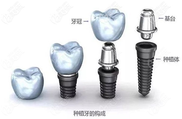 國(guó)產(chǎn)種植體和進(jìn)口種植體的區(qū)別 國(guó)產(chǎn)種植體和進(jìn)口種植體的區(qū)別