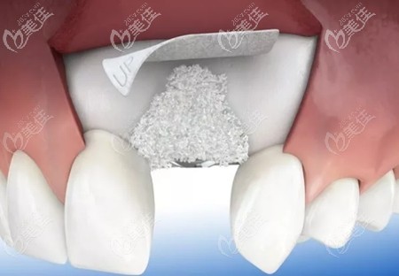 種植牙填充的骨粉