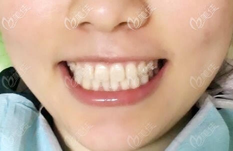 輕微骨性凸嘴戴美國奧美科金屬自鎖托槽就能把牙齒矯正好啦