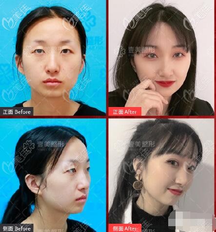 朱建瑩醫(yī)生韓范單眼皮術(shù)前術(shù)后對比