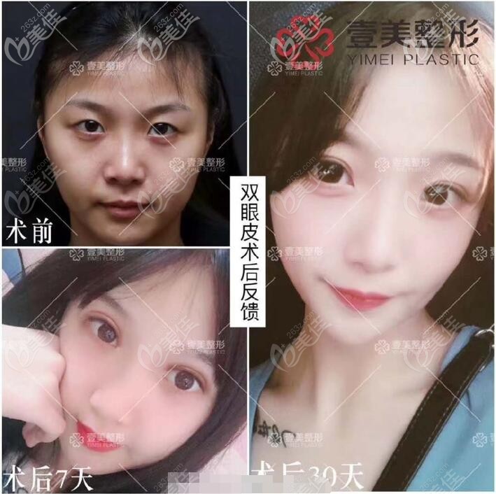 楊文敬醫(yī)生隱適弧美眼術(shù)術(shù)后30天效果圖