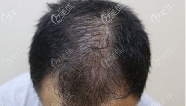 頭頂頭發(fā)稀疏脫落的現(xiàn)象