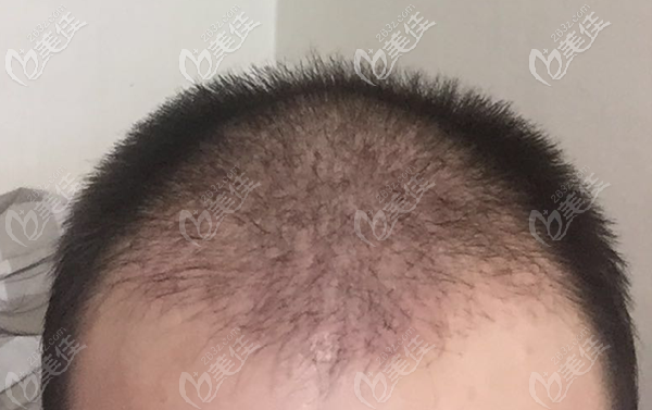 植發(fā)術(shù)后脫落期，原生發(fā)會有掉落情況