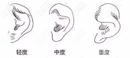 杯狀耳的程度