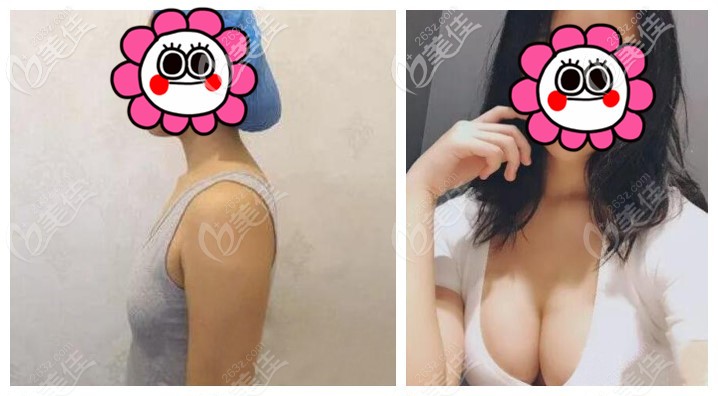 羅盛康隆胸技術(shù)怎么樣？