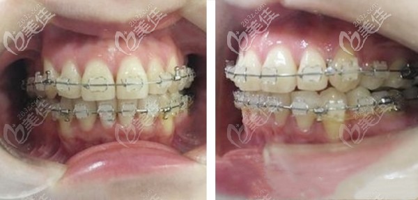 與其糾結(jié)大齡矯正牙齒是否有必要,不妨查看我32歲做虎牙正畸的效果哦