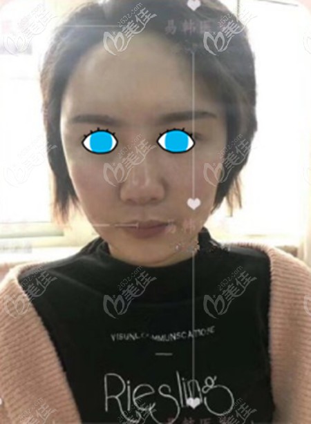 真沒想到40歲的我在信陽東方藝做面部自體脂肪填充后，還可以這么美