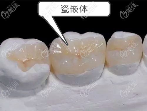 瓷嵌體在牙模上的示意圖 瓷嵌體在牙模上的示意圖