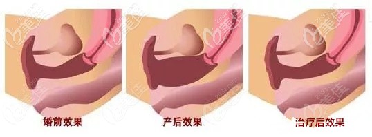 激光縮陰可達(dá)到2指的效果