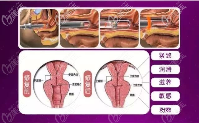 激光縮陰菲蜜麗的原理