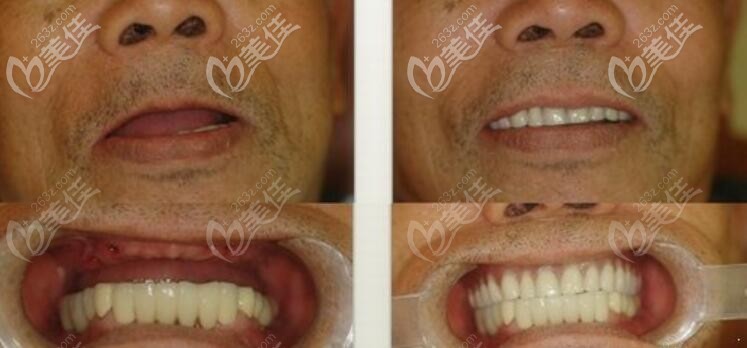 老年人牙缺失做全口種植牙案例前后效果對比圖