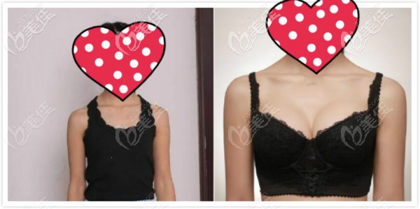 脂肪膠隆胸效果圖對比