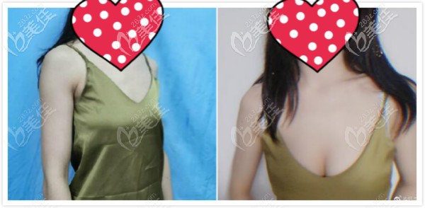 自體脂肪隆胸6個(gè)月效果圖