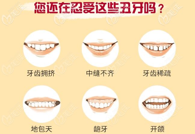 時(shí)代天使隱形矯正適應(yīng)癥 時(shí)代天使隱形矯正適應(yīng)癥