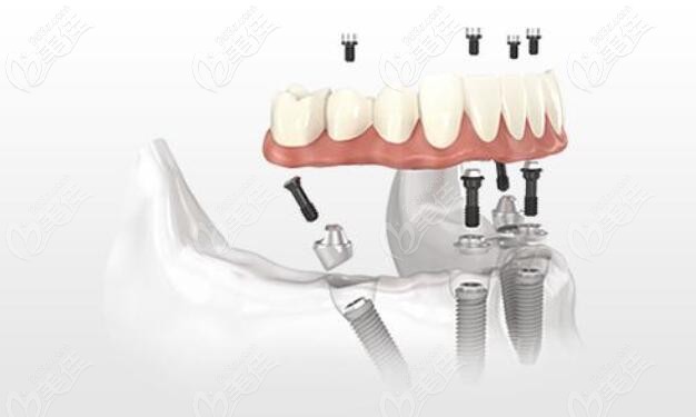 半口all-on-4種植牙 半口all-on-4種植牙