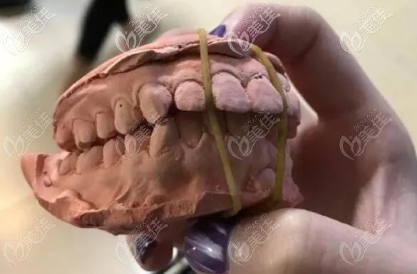 戴牙套可以改善骨性凸嘴嗎	