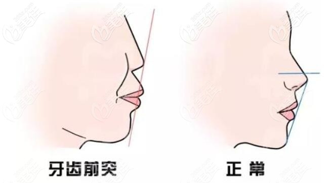 輕微骨性凸嘴戴牙套有用嗎 輕微骨性凸嘴戴牙套有用嗎