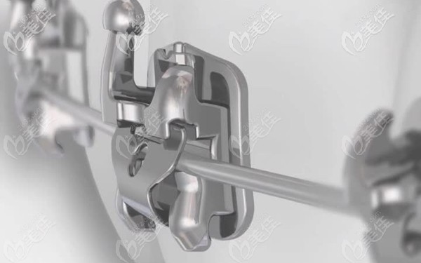 自鎖托槽示意圖