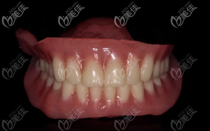 bps吸附性義齒 bps吸附性義齒