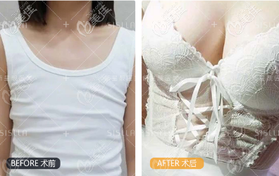 花6萬(wàn)多找北京新星靚李偉民做的點(diǎn)對(duì)點(diǎn)脂肪隆胸效果 花6萬(wàn)多找北京新星靚李偉民做的點(diǎn)對(duì)點(diǎn)脂肪隆胸效果