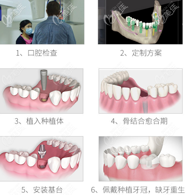 深圳光美種植牙過(guò)程 深圳光美種植牙過(guò)程