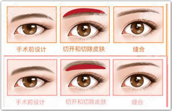 普通提眉手術方式有眉上和眉下切口
