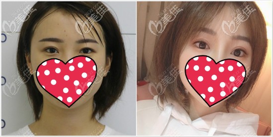 真人案例：提眉術前術后效果對比圖