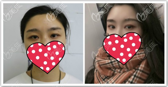 普通提眉手術前后效果對比圖片