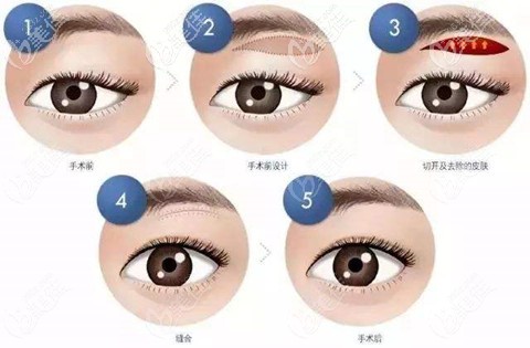 三層筋膜提美手術(shù)過程 三層筋膜提美手術(shù)過程