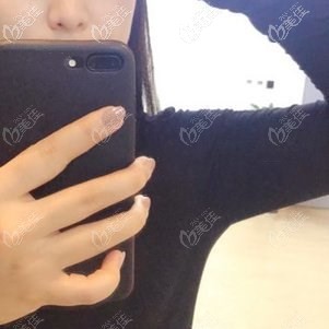 選擇做水動力手臂吸脂的原因是，能避免出現(xiàn)皮膚褶皺