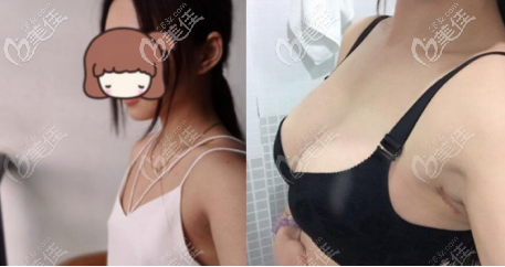 做了傲諾拉璀璨240cc假體后可以用力捏都沒(méi)有關(guān)系