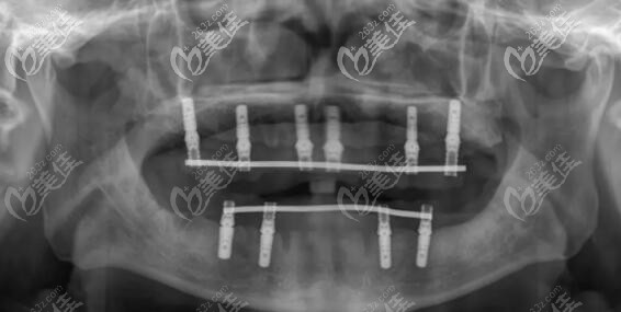 他做的全口即刻負(fù)重種植牙只用了10顆植體(上半口6顆,下半口4顆)